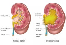 Hẹp Khúc Nối Bể Thận – Niệu Quản (UPJO) Theo Từng Nhóm Tuổi