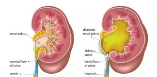 Hẹp Khúc Nối Bể Thận – Niệu Quản (UPJO) Theo Từng Nhóm Tuổi