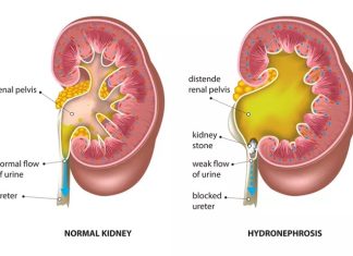Hẹp Khúc Nối Bể Thận – Niệu Quản (UPJO) Theo Từng Nhóm Tuổi