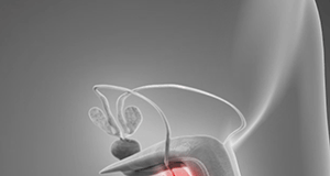 ĐAU BÌU Ở NAM GIỚI: CÁC NGUYÊN NHÂN BỆNH LÝ, QUY TRÌNH CHẨN ĐOÁN VÀ HƯỚNG ĐIỀU TRỊ CẬP NHẬT