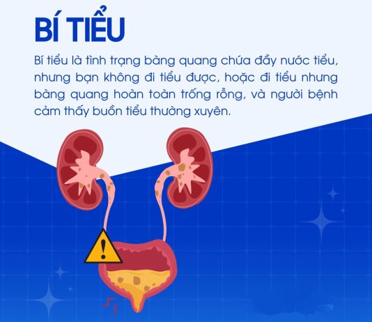 Bí tiểu cấp sau phẫu thuật nội soi bóc nhân tuyến tiền liệt